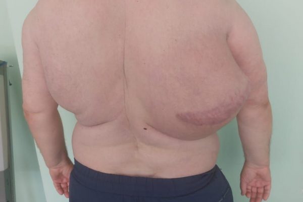 Хирурги Раменской ОБ удалили липому весом более 10 кг